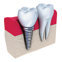 Dental Bridges- Canton Dental