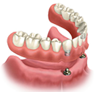 Denture Stabilization - Canton Dental