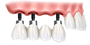 An implant-supported bridge is a great solution for replacing multiple missing teeth.