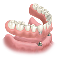 Dentures - Denture Stabilization