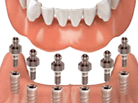 Implant-Supported Dentures - Canton Dental