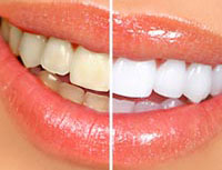 Cosmetic Dentistry in Canton