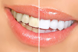 Teeth Whitening - Canton Dental